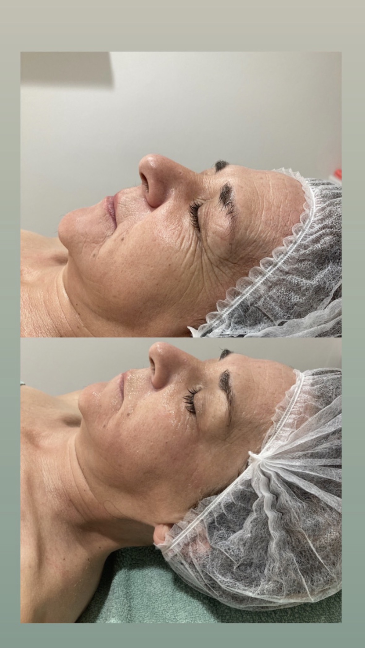 Tratamiento facial antiedad